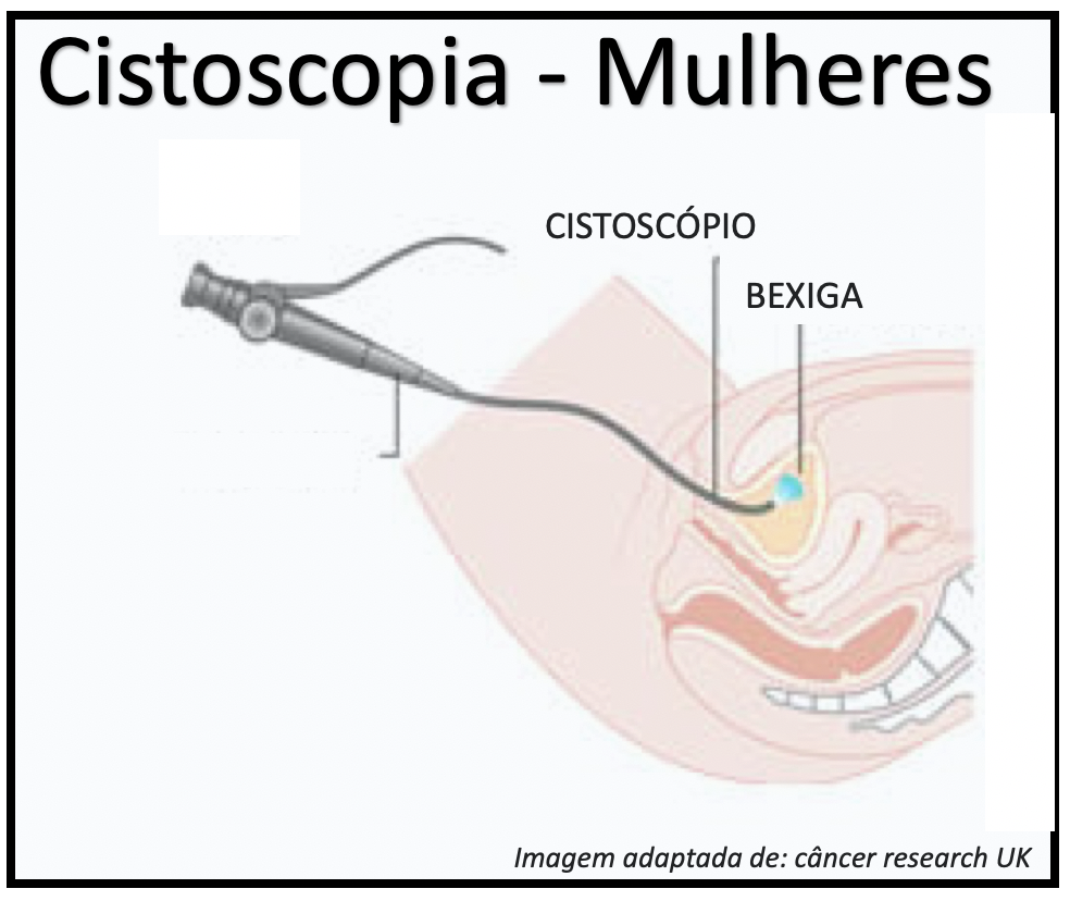 Cistoscopia o que é indicações como é feita