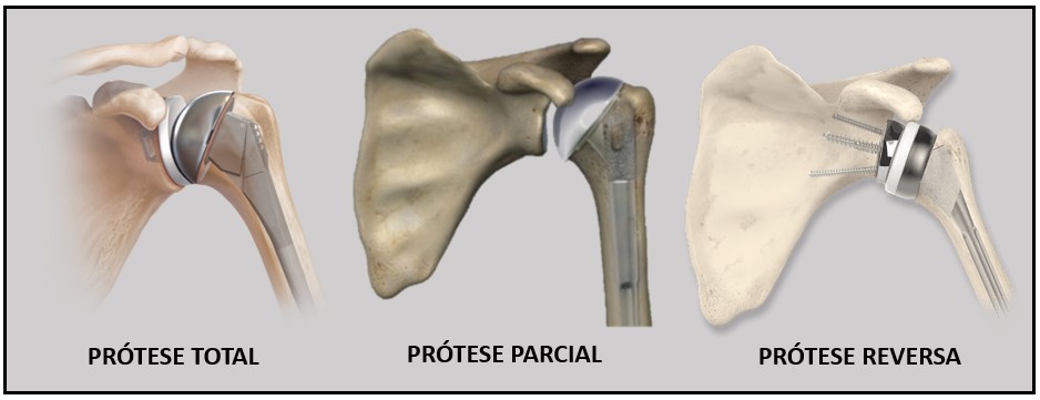 Prótese Do Ombro (Artroplastia): Reabilitação, Resultado