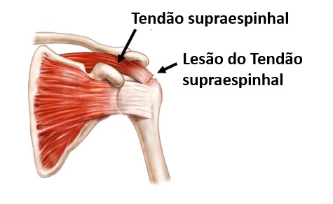 Ruptura do Tendão Supraespinhal diagnóstico tratamento