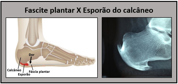 Fascite plantar 2
