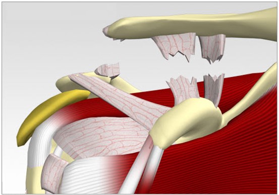 luxação acromioclavicular