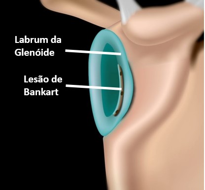 Lesão de Bankart 1