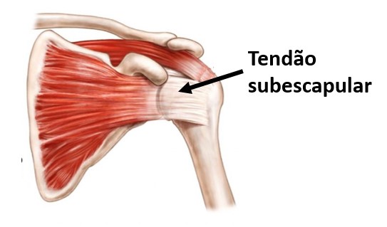 Lesão do Subescapular 3