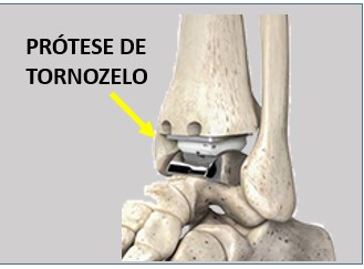 prótese de tornozelo
