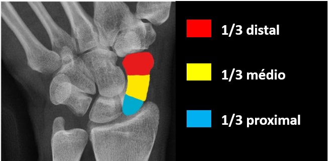 Fratura do escafóide o que é causa diagnóstico e tratamento