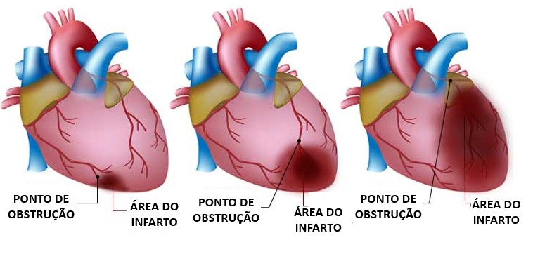 Infarto Agudo Do Mioc rdio O Que Sintomas