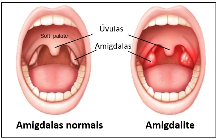 amigdalite