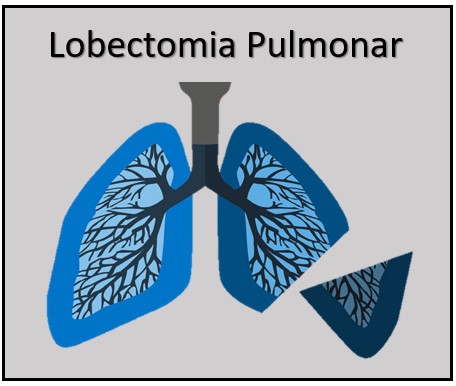 lobectomia pulmonar