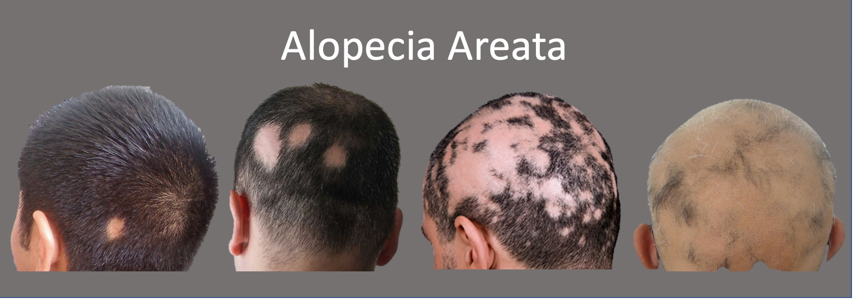 Alopecia Areata Medicina De Excel Ncia