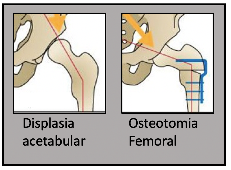 Displasia acetabular / osteotomia femoral