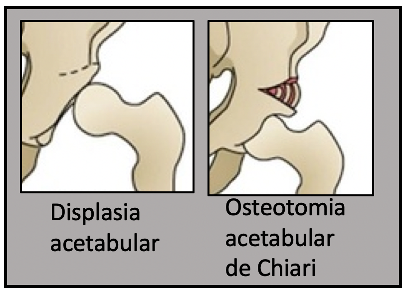 Displasia acetabular ; osteotomia acetabular de chiari