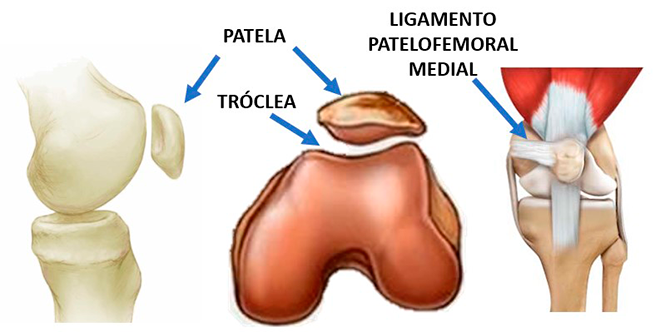 Luxação da Patela na infancia 1