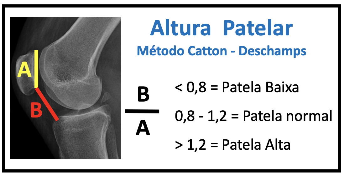 Luxação da Patela na infancia 3