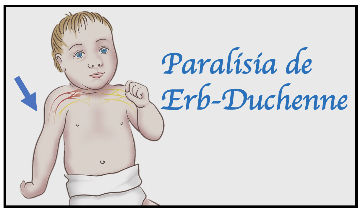 Paralisia Obstetrica 1