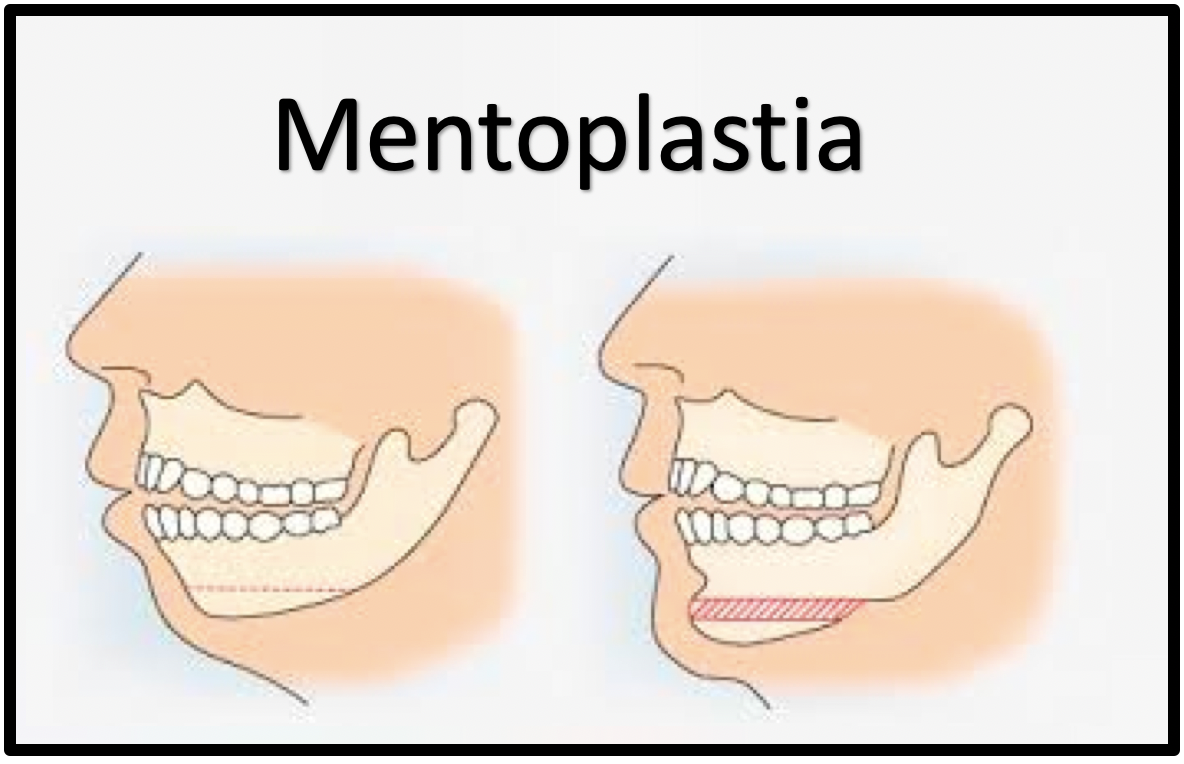 mentoplastia 1