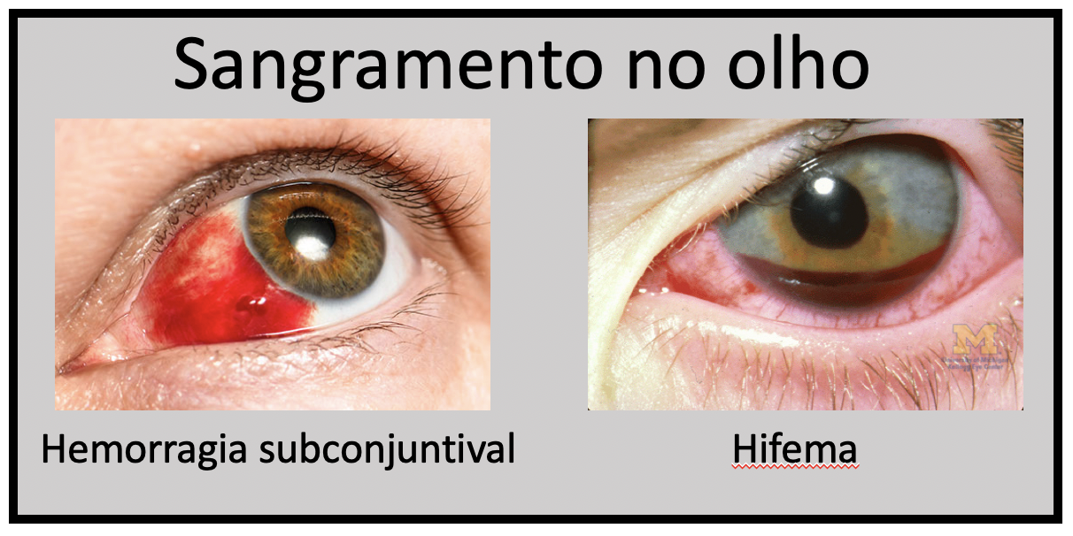 Trauma no olho1