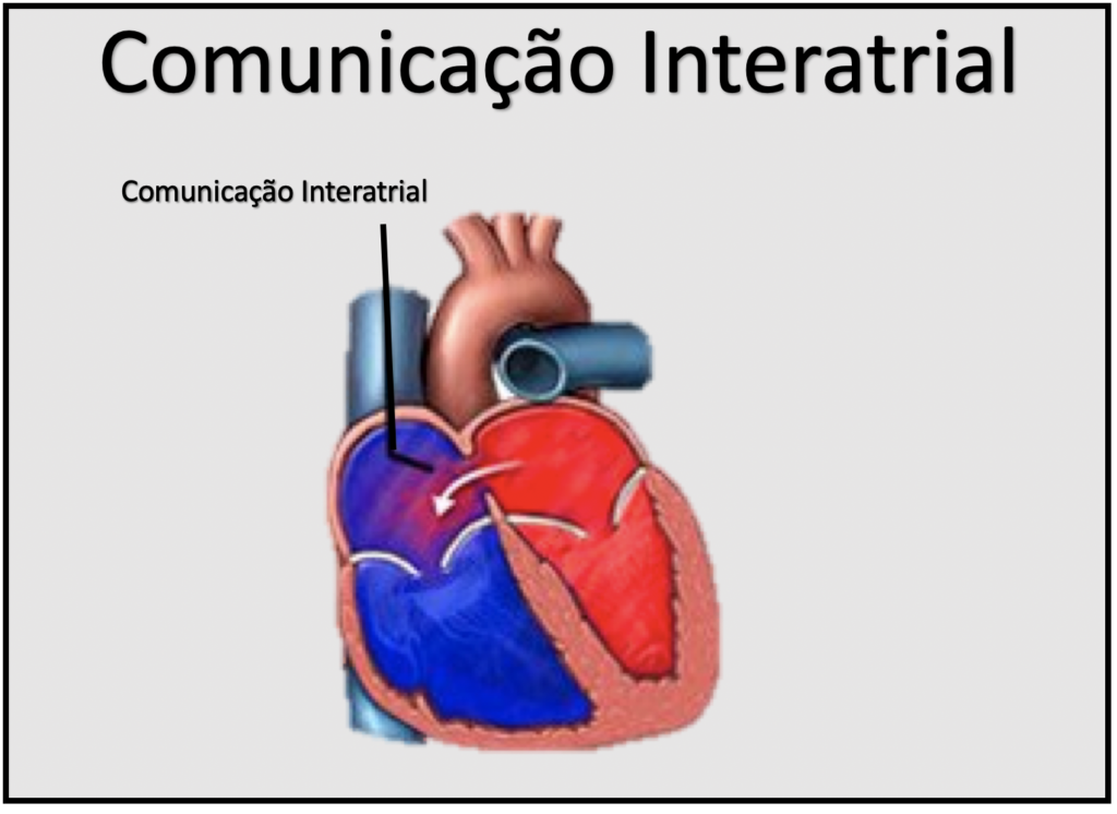 Comunicação Interatrial (CIA) - Medicina de Excelência