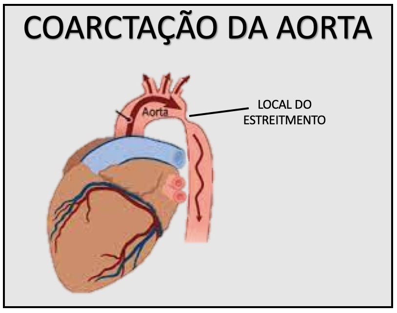 coarcta-o-da-aorta-medicina-de-excel-ncia