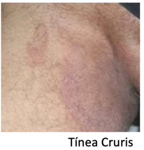 Tinea Cruris (Micose na Virilha) - Medicina de Excelência