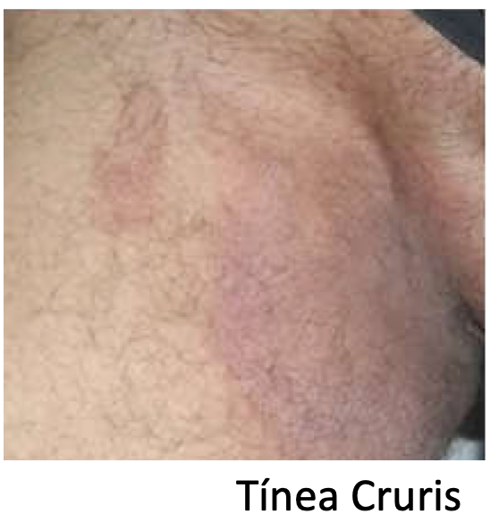 Micose na virilha (tinea cruris): quais são as causas e como tratá