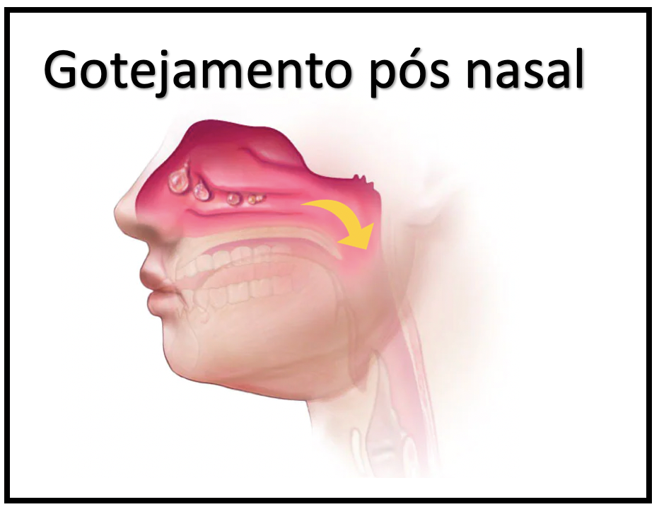 Gotejamento Pós-Nasal: o que é, sintomas, diagnóstico, tratamento.