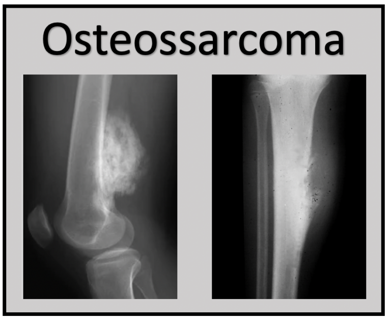 Osteossarcoma - Medicina de Excelência