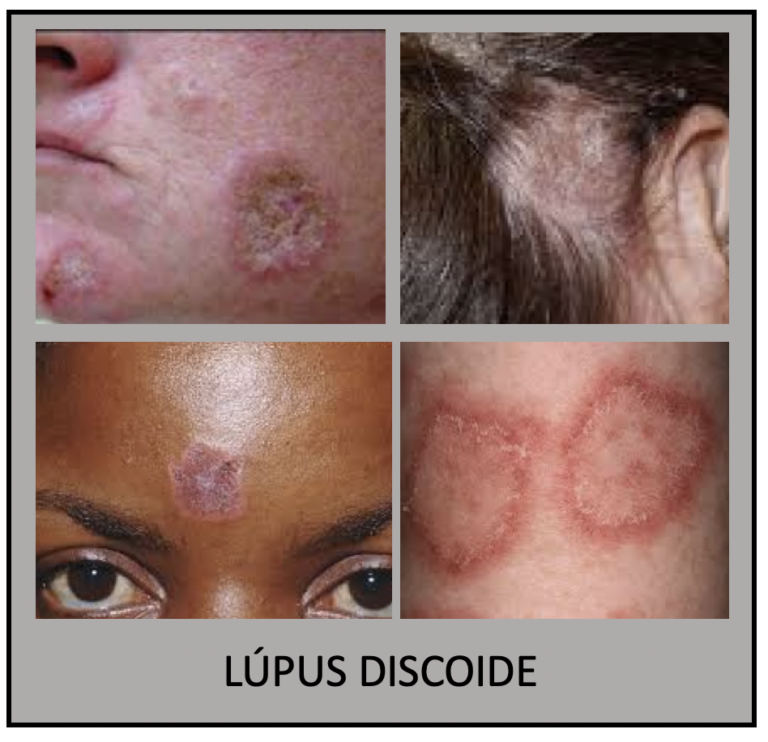Lúpus Eritematoso Sistêmico | Reumatologia | Medicina de Excelência